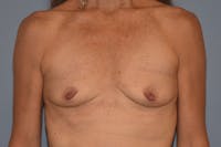 Breast Augmentation Before & After Gallery - Patient 318191 - Image 1