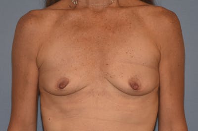 Breast Augmentation Before & After Gallery - Patient 318191 - Image 1