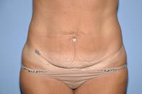Tummy Tuck Before & After Gallery - Patient 273813 - Image 1