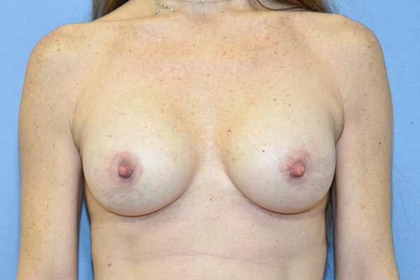 Breast Augmentation Before & After Gallery - Patient 318191 - Image 2