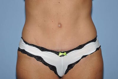 Tummy Tuck Before & After Gallery - Patient 273813 - Image 2