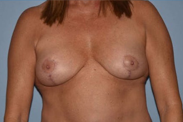 Breast Implant Removal Before & After Gallery - Patient 222446 - Image 2