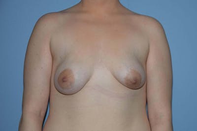 Breast Asymmetry Before & After Gallery - Patient 272250 - Image 1