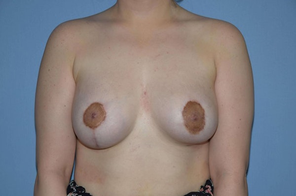 Breast Asymmetry Before & After Gallery - Patient 272250 - Image 2