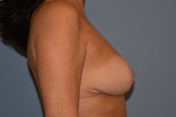 Breast Reduction Before & After Gallery - Patient 109594 - Image 6