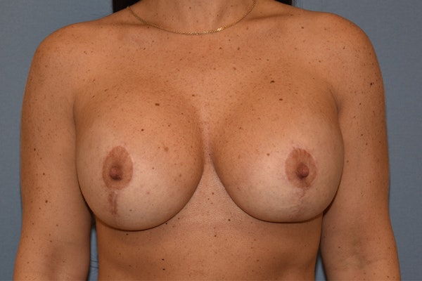 Breast Revision Before & After Gallery - Patient 415141 - Image 2