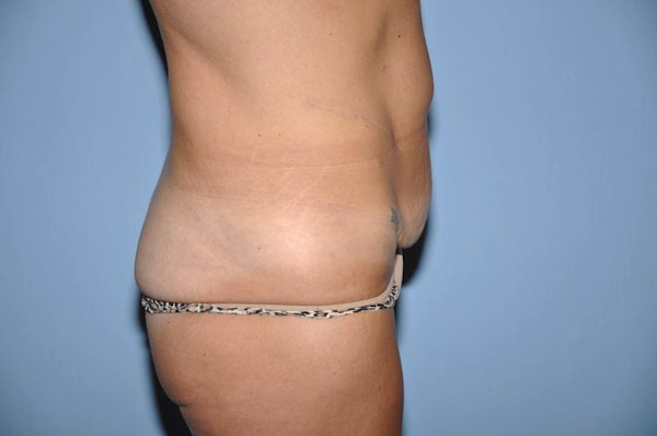 Tummy Tuck Before & After Gallery - Patient 273813 - Image 5
