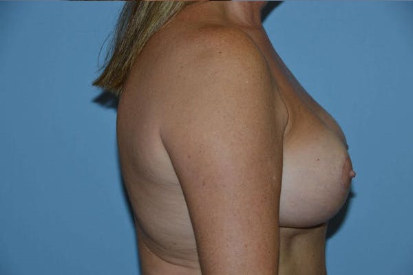 Breast Implant Removal Before & After Gallery - Patient 222446 - Image 5