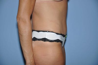 Tummy Tuck Before & After Gallery - Patient 273813 - Image 6