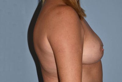 Breast Implant Removal Before & After Gallery - Patient 222446 - Image 6