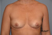 Breast Augmentation Before & After Gallery - Patient 204752 - Image 1