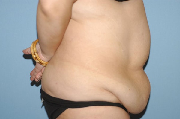 Tummy Tuck Before & After Gallery - Patient 123497 - Image 5