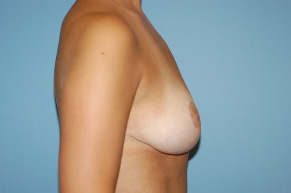 Breast Lift Before & After Gallery - Patient 100228 - Image 6