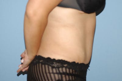 Tummy Tuck Before & After Gallery - Patient 123497 - Image 6
