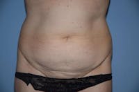 Tummy Tuck Before & After Gallery - Patient 945376 - Image 1