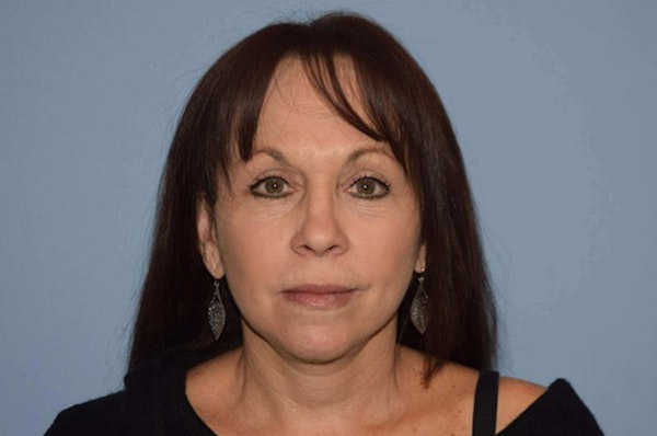 Facelift Before & After Gallery - Patient 204708 - Image 2