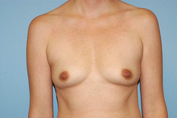 Breast Augmentation Before & After Gallery - Patient 372424 - Image 1