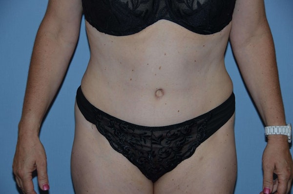 Tummy Tuck Before & After Gallery - Patient 945376 - Image 2