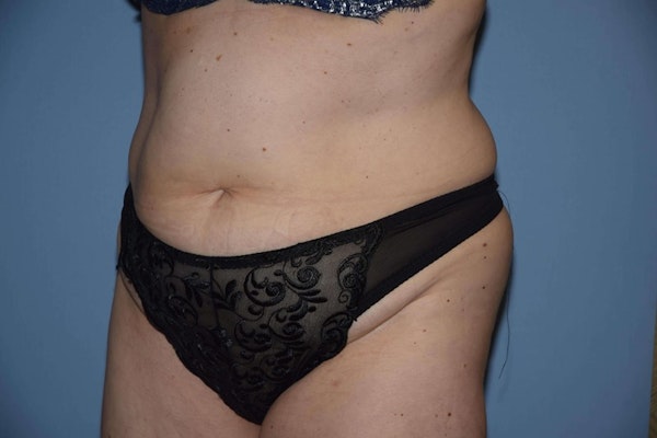 Tummy Tuck Before & After Gallery - Patient 945376 - Image 3