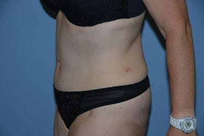 Tummy Tuck Before & After Gallery - Patient 945376 - Image 4