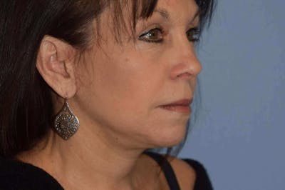 Facelift Before & After Gallery - Patient 204708 - Image 4