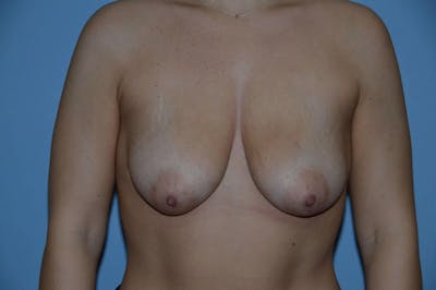 Breast Augmentation Lift Before & After Gallery - Patient 137449 - Image 1