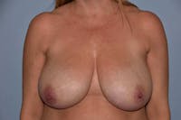 Breast Reduction Before & After Gallery - Patient 182886 - Image 1