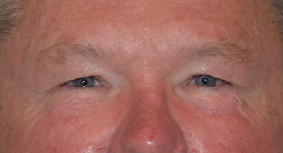 Eyelid Lift Before & After Gallery - Patient 353866 - Image 1