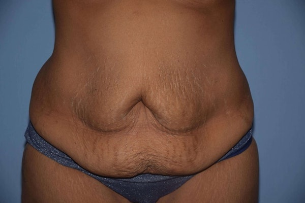Tummy Tuck Before & After Gallery - Patient 508357 - Image 1