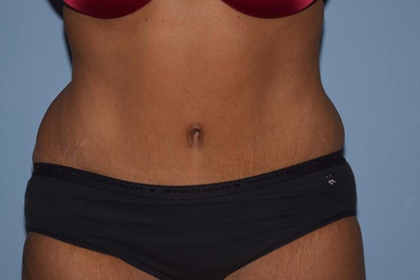 Tummy Tuck Before & After Gallery - Patient 508357 - Image 2