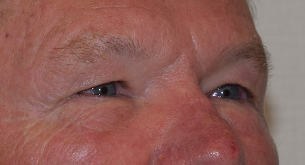 Eyelid Lift Before & After Gallery - Patient 353866 - Image 3