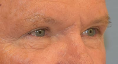 Eyelid Lift Before & After Gallery - Patient 353866 - Image 4