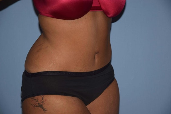Tummy Tuck Before & After Gallery - Patient 508357 - Image 4
