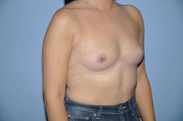 Breast Augmentation Before & After Gallery - Patient 273003 - Image 3