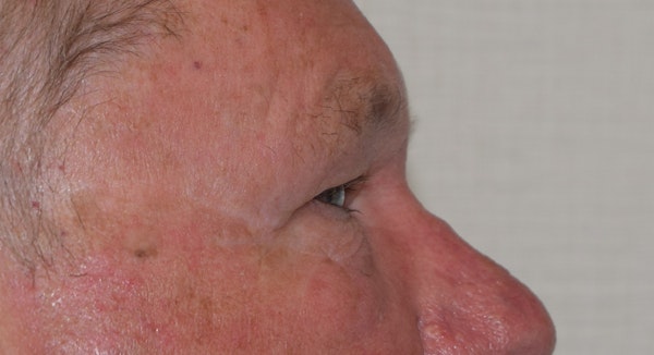 Eyelid Lift Before & After Gallery - Patient 353866 - Image 5