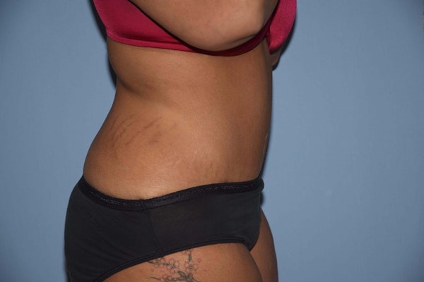 Tummy Tuck Before & After Gallery - Patient 508357 - Image 6