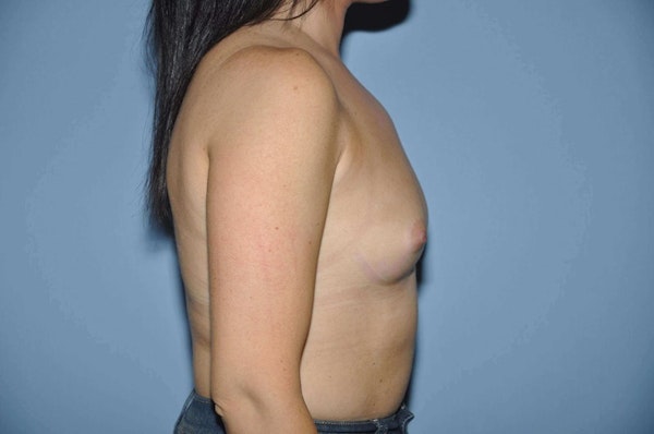 Breast Augmentation Before & After Gallery - Patient 273003 - Image 5