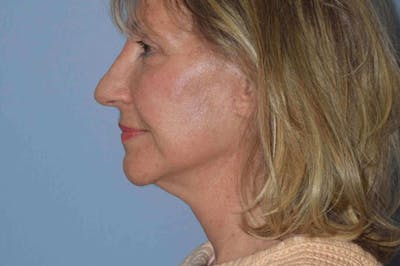 Facelift Before & After Gallery - Patient 404760 - Image 6
