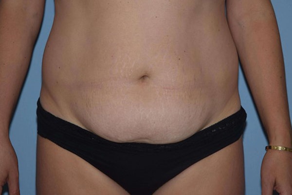 Tummy Tuck Before & After Gallery - Patient 322195 - Image 1
