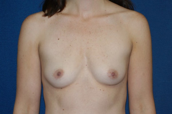 Breast Augmentation Before & After Gallery - Patient 395533 - Image 1