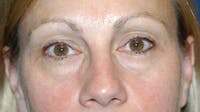 Eyelid Lift Before & After Gallery - Patient 346968 - Image 1