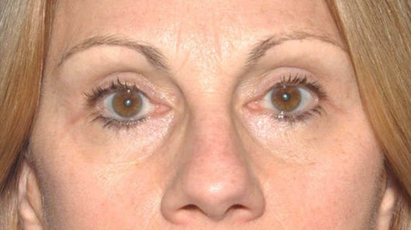 Eyelid Lift Before & After Gallery - Patient 346968 - Image 2