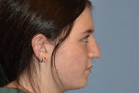 Rhinoplasty Before & After Gallery - Patient 215804 - Image 1