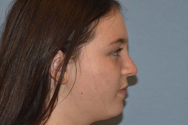 Rhinoplasty Before & After Gallery - Patient 215804 - Image 2