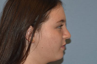 Rhinoplasty Before & After Gallery - Patient 215804 - Image 2