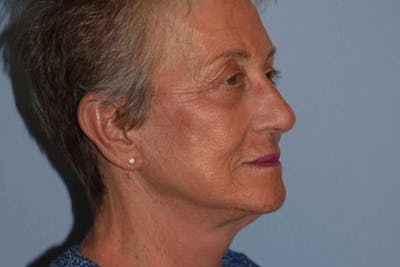 Facelift Before & After Gallery - Patient 246413 - Image 8