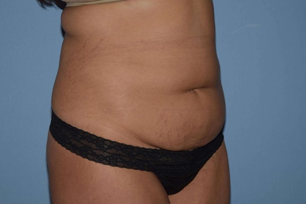 Tummy Tuck Before & After Gallery - Patient 172987 - Image 3