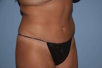 Tummy Tuck Before & After Gallery - Patient 172987 - Image 4