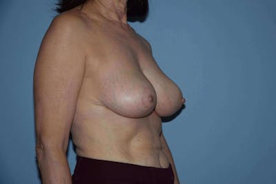 Breast Reduction Before & After Gallery - Patient 346318 - Image 4