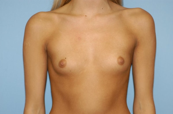 Breast Augmentation Before & After Gallery - Patient 178772 - Image 1